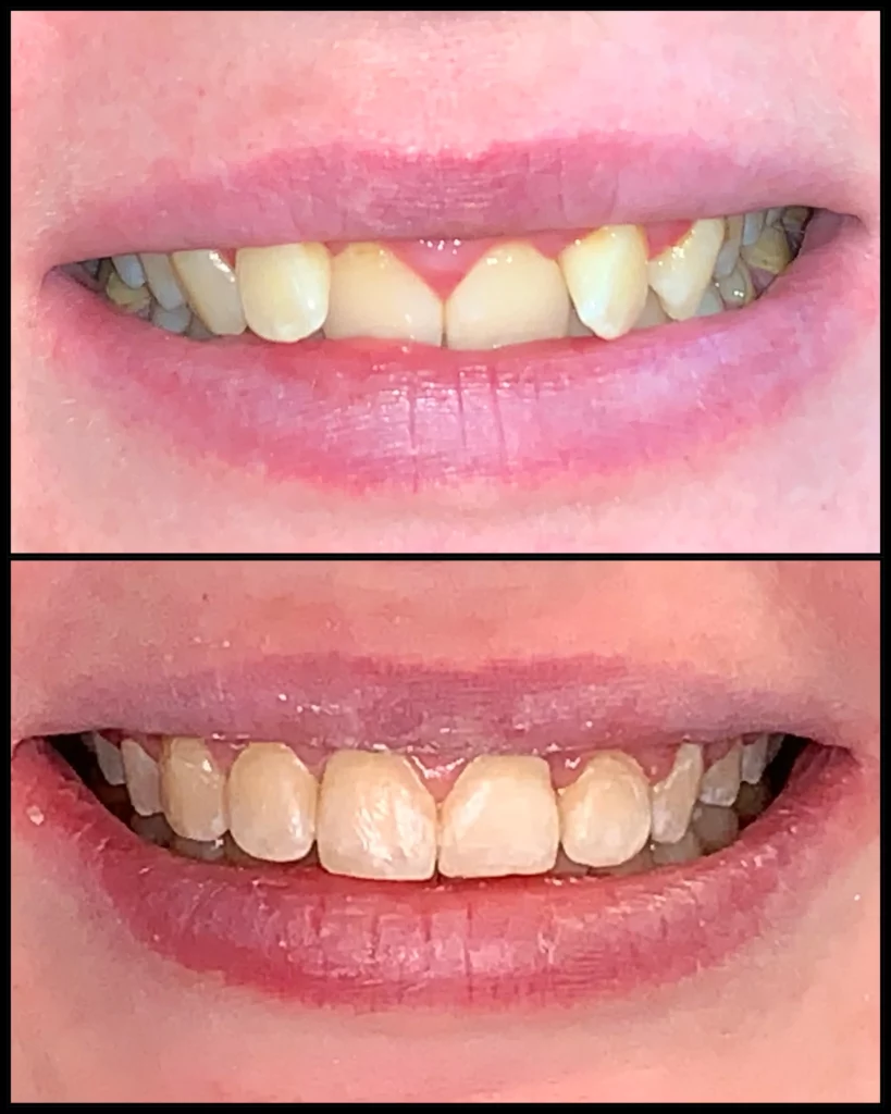 Before and after: crooked, overlapping front teeth (top) and straight, even teeth (bottom)
