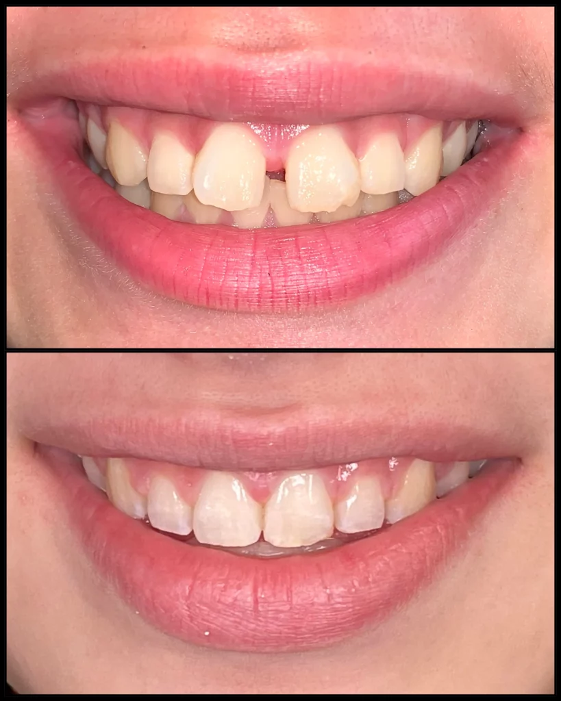 Before and after: a gap between the two front teeth (top) and the gap closed (bottom)
