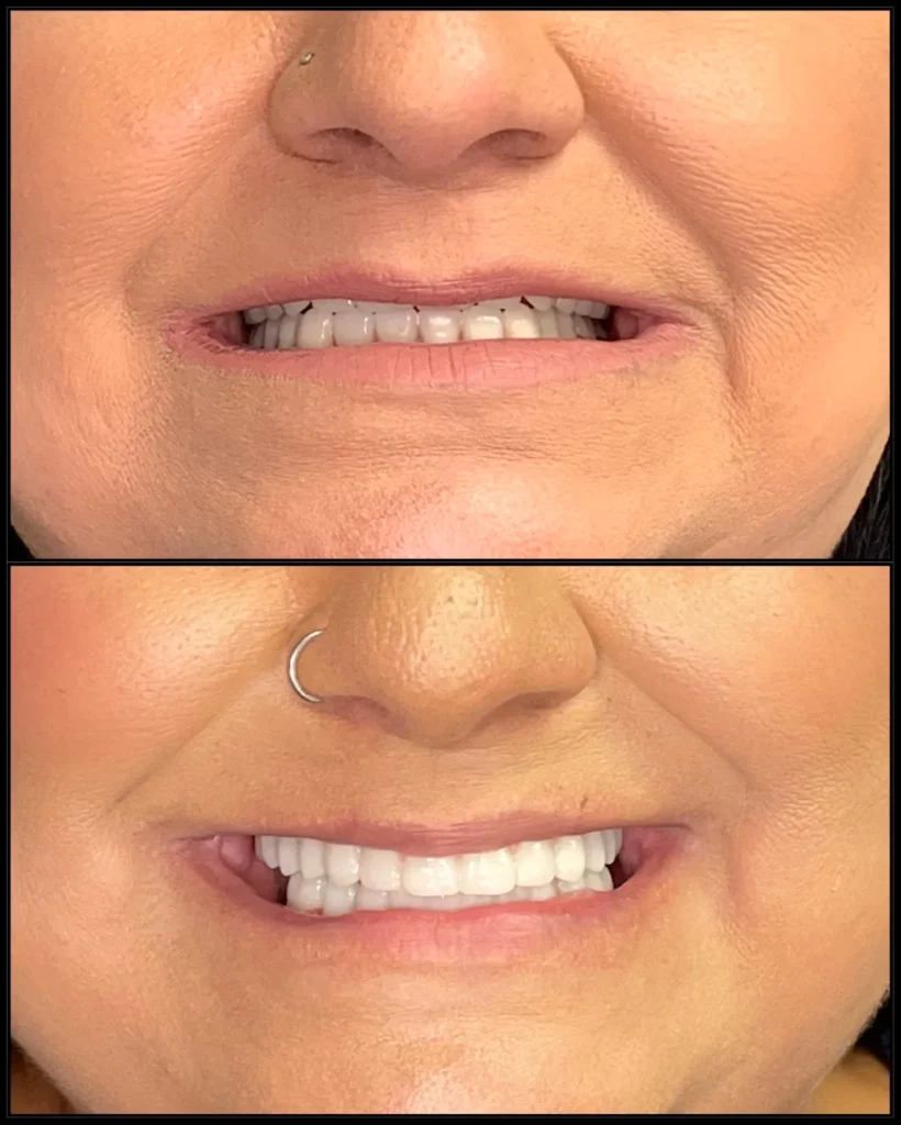 Before and after: small, dark and worn teeth (top) and a bright white, complete smile (bottom)