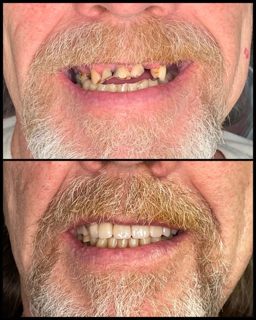 Before and after: a bearded man with broken and missing teeth (top) and a complete, restored smile (bottom)