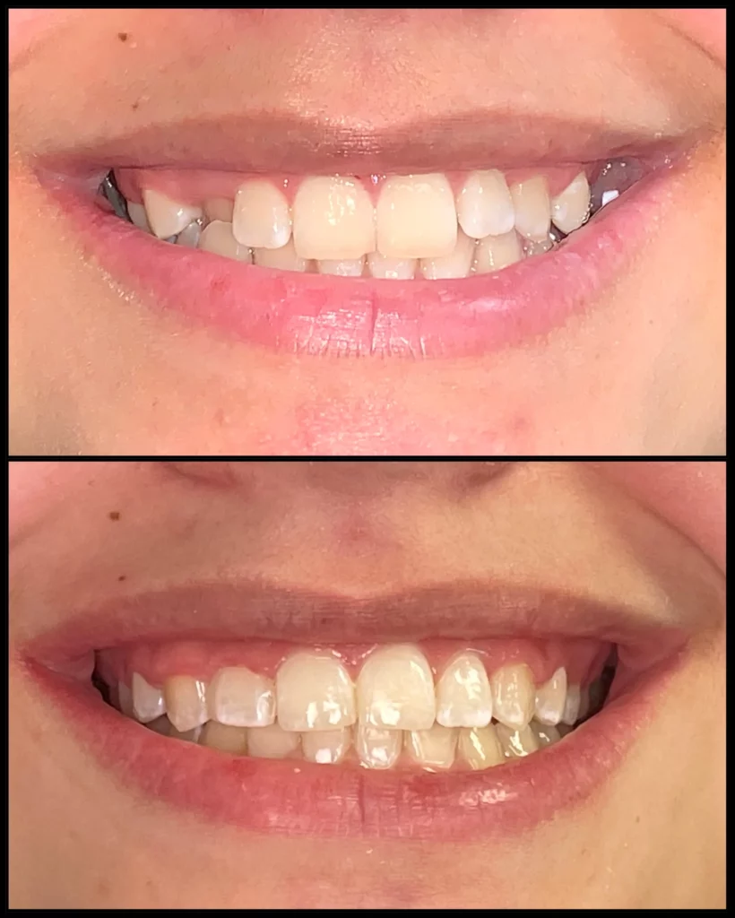 Before and after: uneven, slightly crowded teeth (top) and a brighter, straighter smile (bottom)