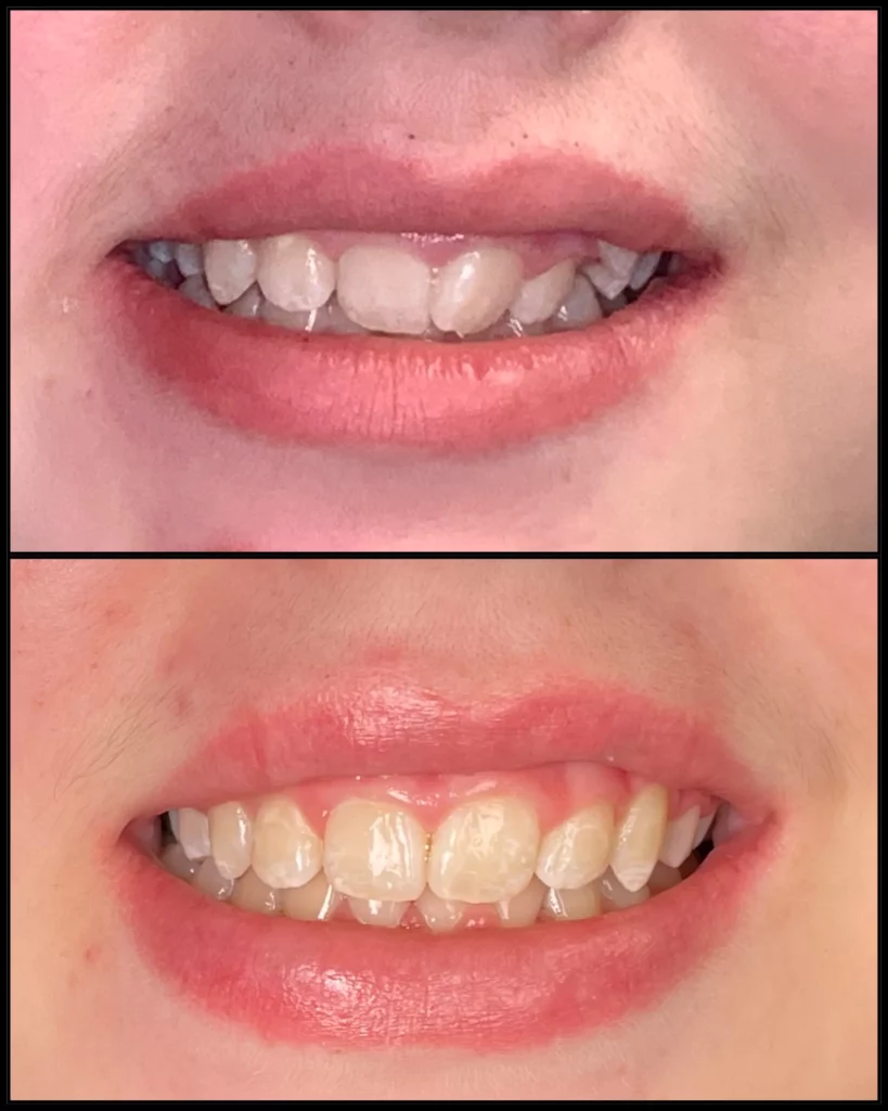 Before and after: uneven, crowded front teeth (top) and a straighter, even smile (bottom)