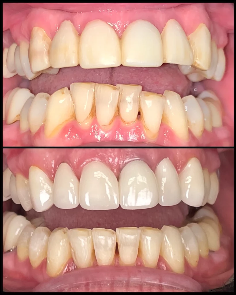 Before and after, close-up: worn and uneven upper front teeth (top) and new, even upper teeth (bottom)