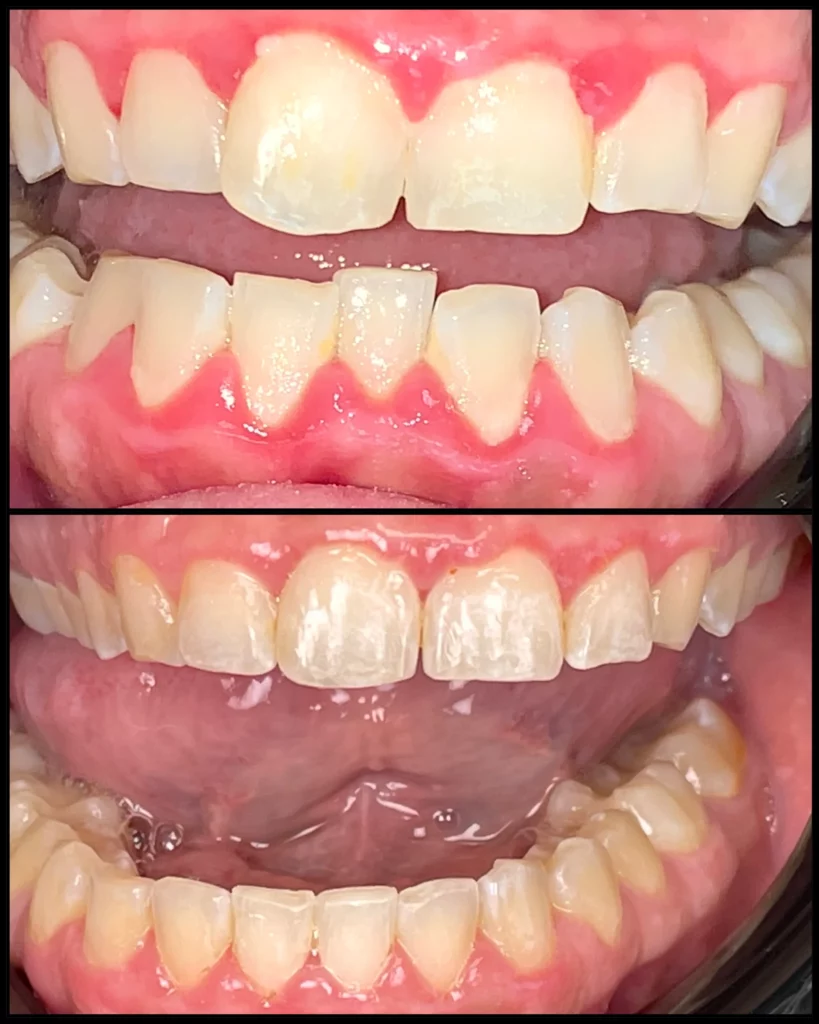 Before and after, close-up: crowded, uneven teeth (top) and restored, even teeth (bottom)
