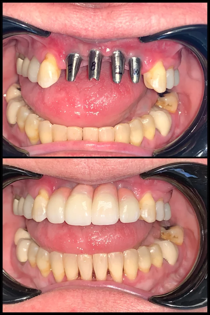 Before and after, close-up: four implant posts in the upper front jaw (top) and the implant-supported teeth in place (bottom)
