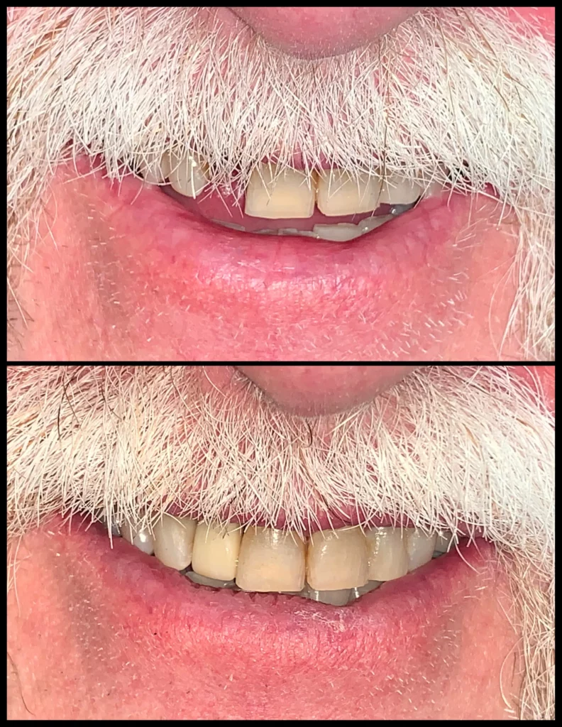 Before and after: a man with a white mustache with worn, missing teeth (top) and a restored full row of teeth (bottom)