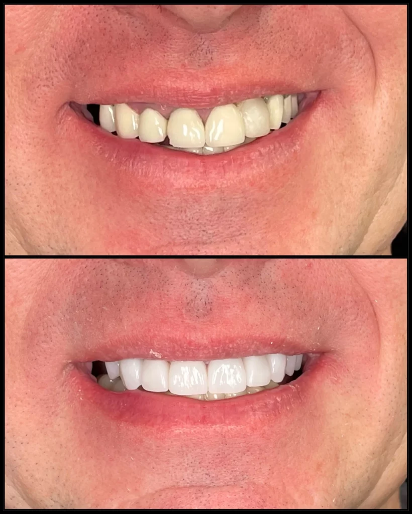 Before and after: small, uneven and discolored teeth (top) and a bright white, even smile (bottom)