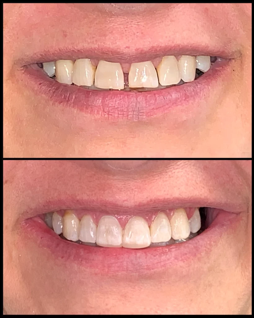 Before and after: gaps and uneven front teeth (top) and a closed, even smile (bottom)