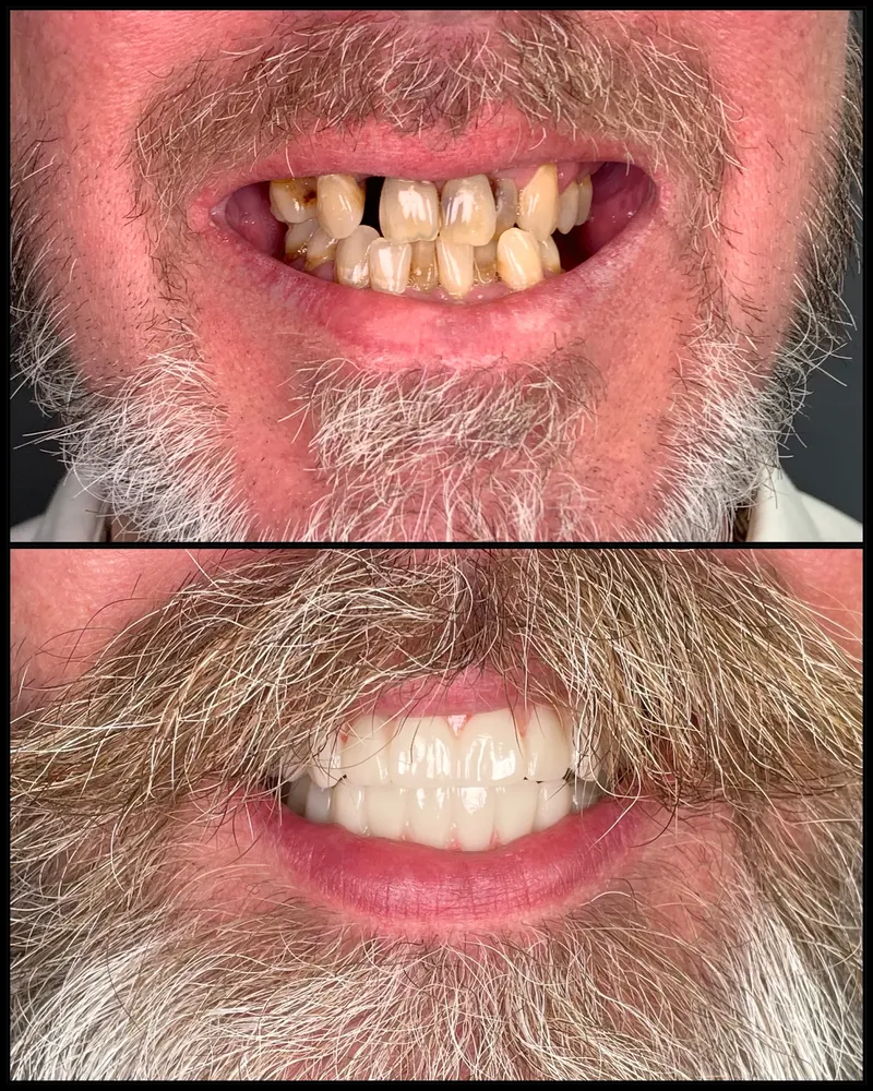 Before and after: a bearded man with broken, discolored teeth (top) and a full, bright new smile (bottom)