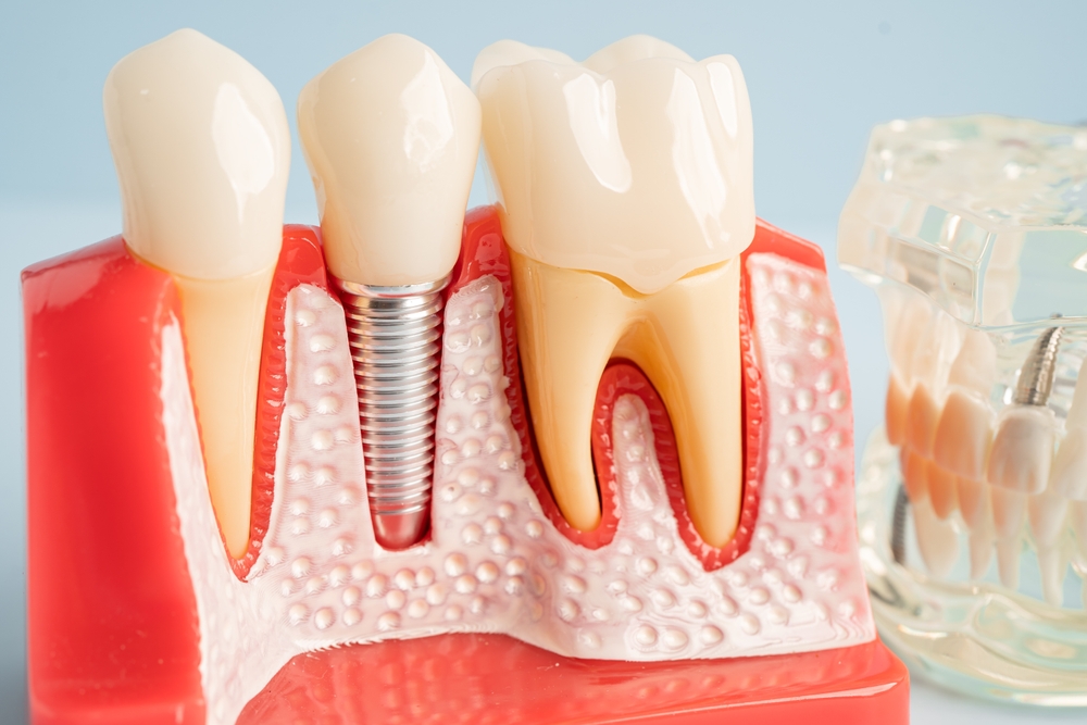Dental model showing an implant crown between natural teeth